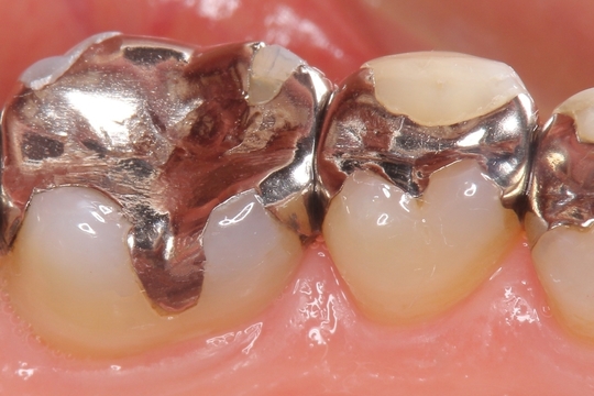 銀歯 4g 銀歯 4g以上 歯科金属 詳細不明 -【一部予約販売】